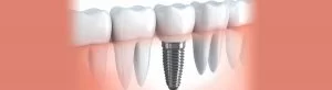 Dental Implants Leicester