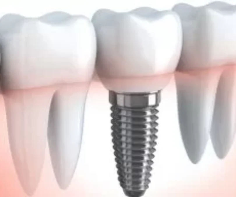 Dental implants Leicester Knighton Dental