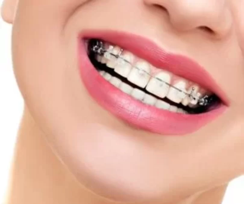 Braces Knighton Dental Leicester