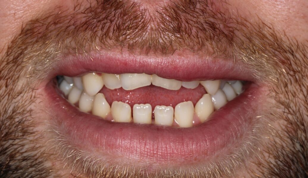 A photo of teeth before invisalign at Knighton Dental Leicester