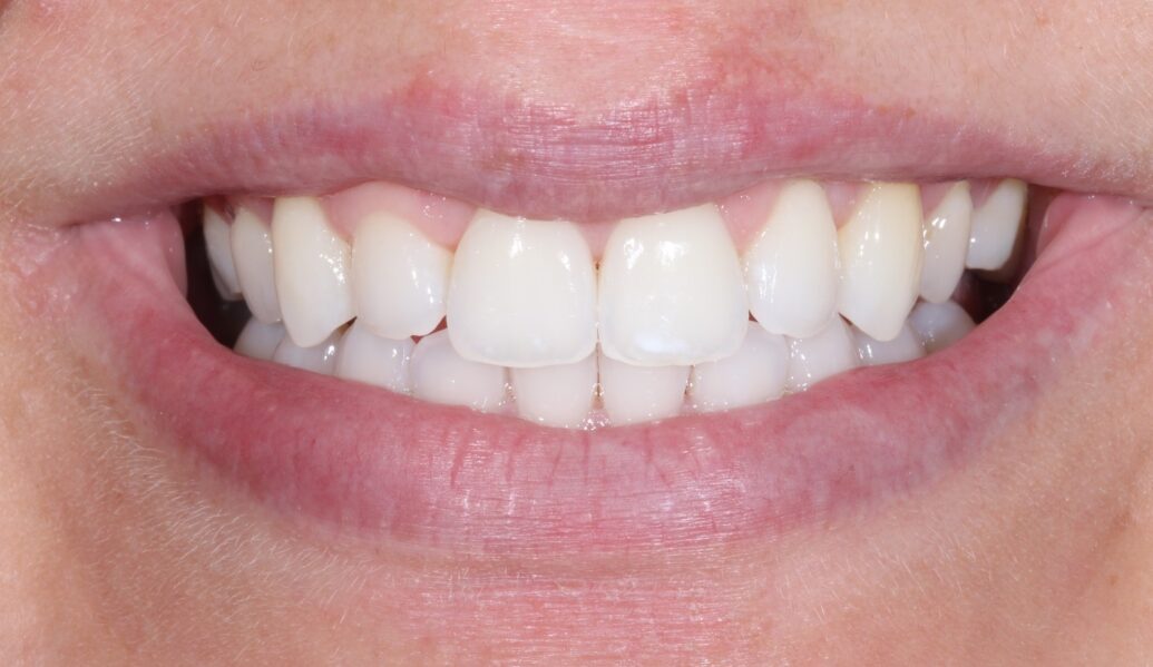 teeth after having Invisalign treatment at Knighton Dental Leicester