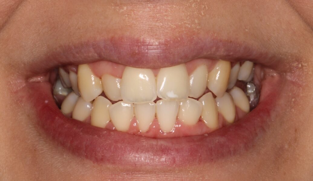 A before photo of teeth before having Invisalign treatment at Knighton Dental Leicester