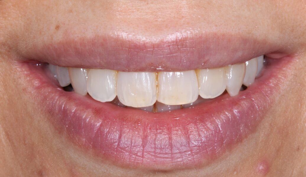 A photo of teeth after having fixed braces at Knighton dental Leicester with Dr Neena Amin