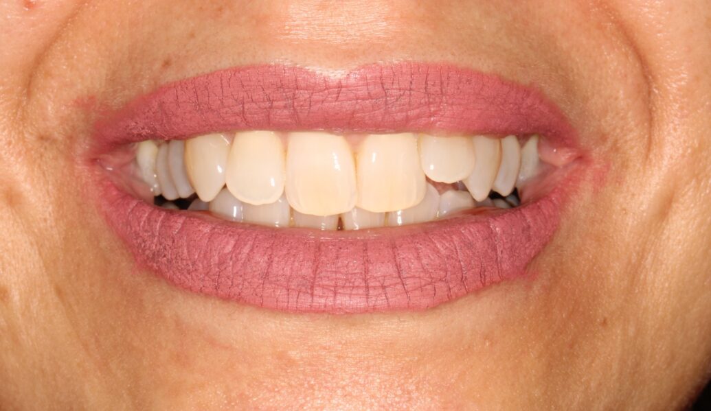 a photo of teeth before having fixed braces at Knighton Dental Leicester