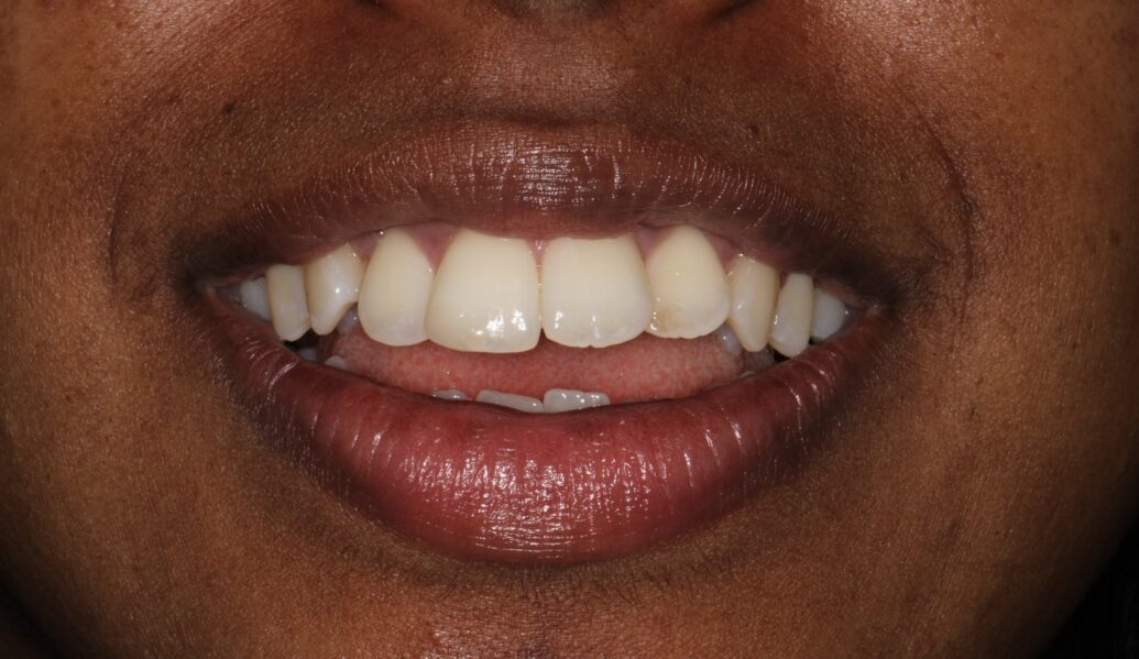 A photo of a smile before having Invisalign treatment