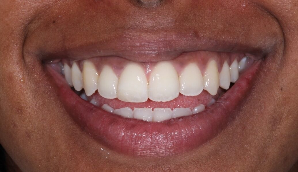 A photo of a smile after Invisalign at Knighton Dental Leicester