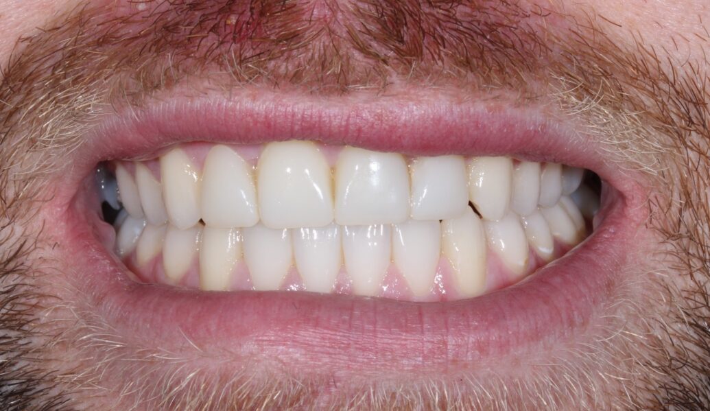 A photo of teeth after having invisalign at Knighton Dental Leicester