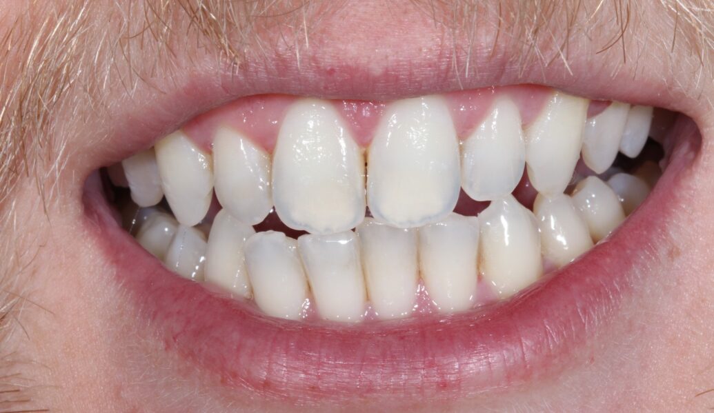 a photo of a smile after having boutique teeth whitening at Knighton Dental Leicester