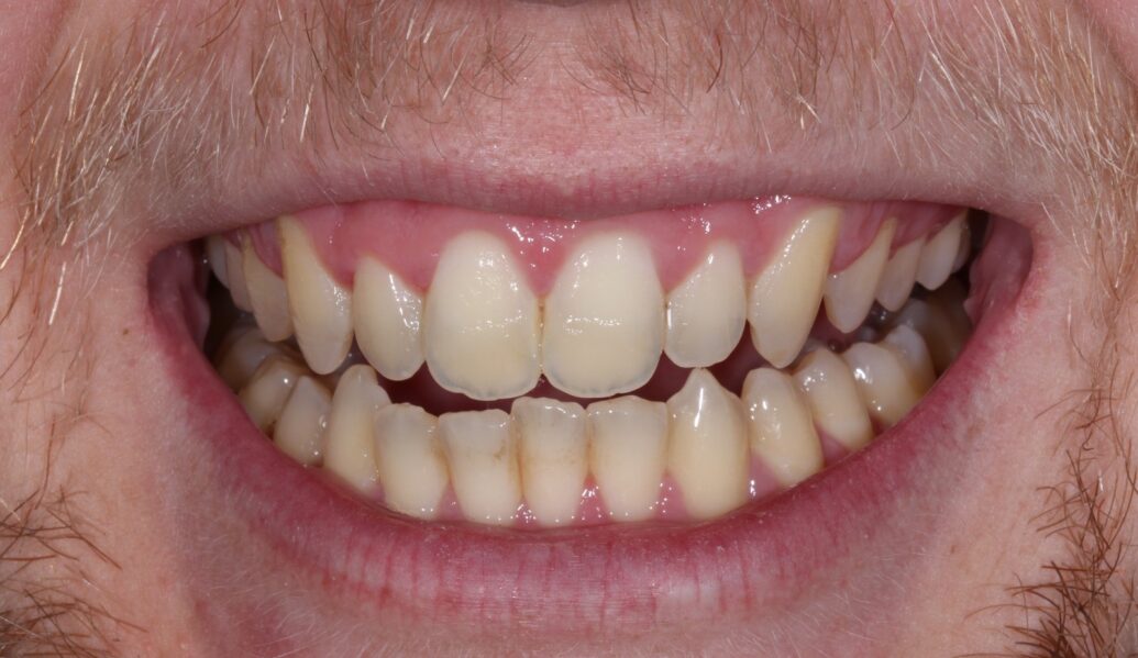A photo of teeth before having boutique whitening at Knighton dental Leicester