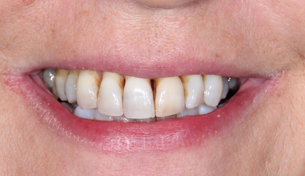 A before photo of a smile before patient having Composite bonding at Knighton Dental Leicester