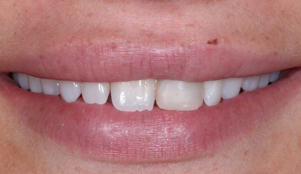 Before - Knighton Dental