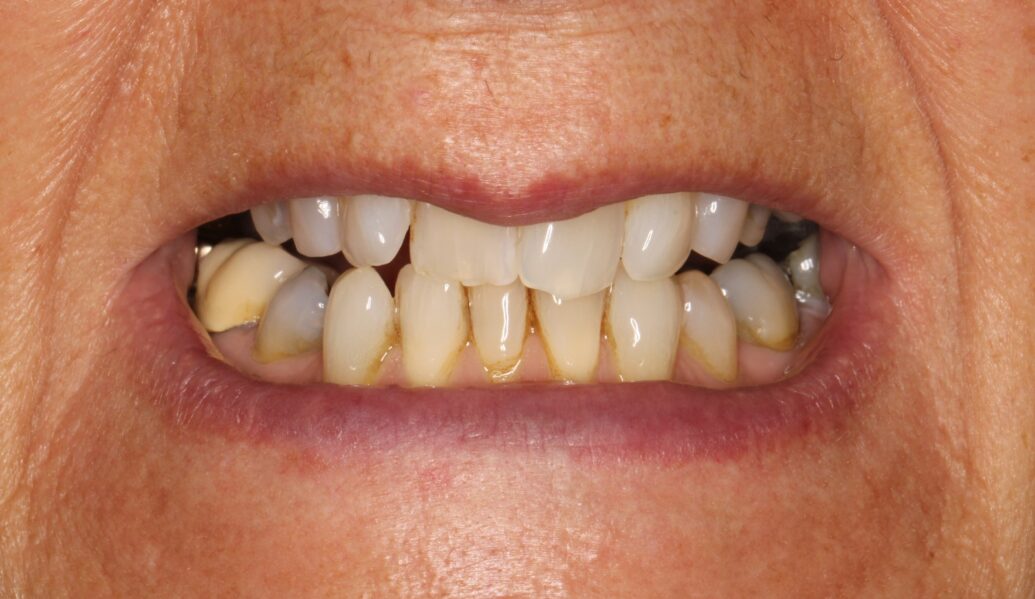 Invisalign & Whitening before