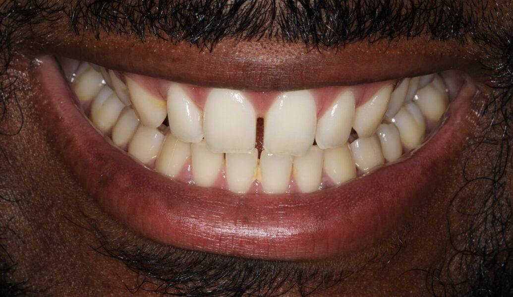 Composite bonding & Whitening before