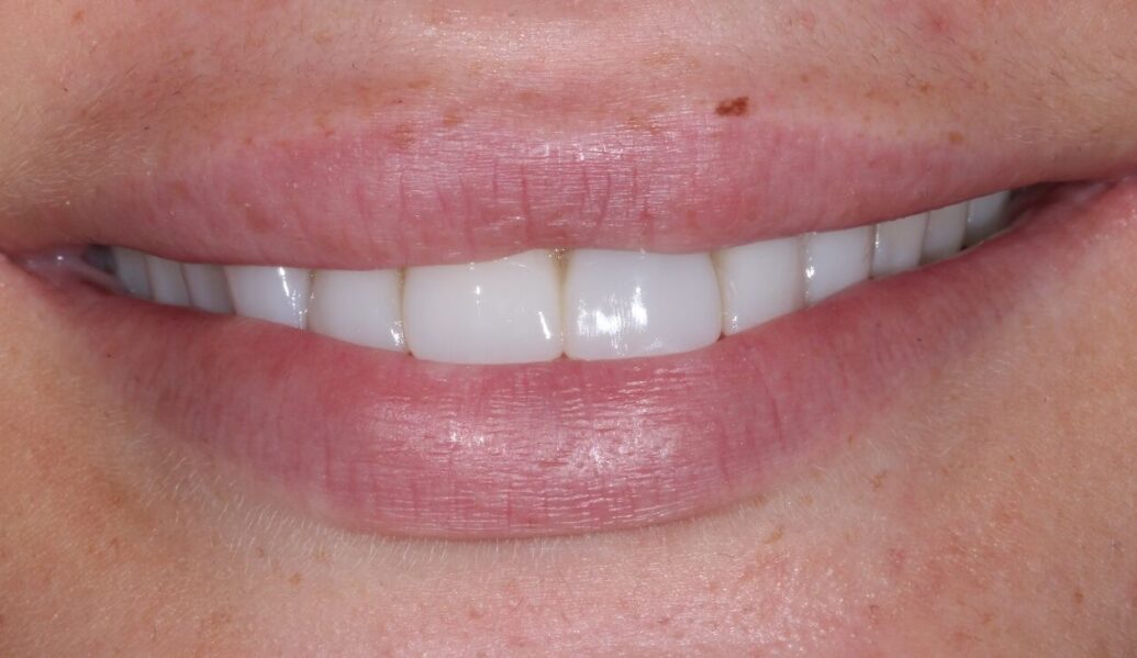 After - Knighton Dental