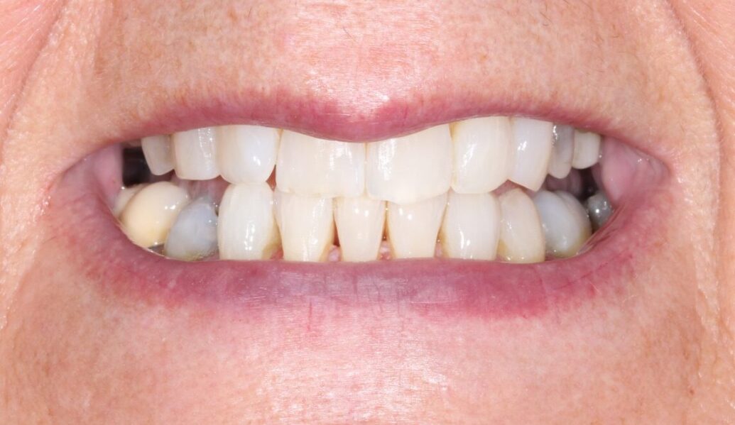 Invisalign & Whitening after