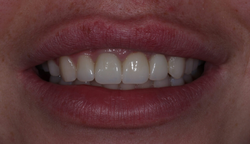 After - Knighton Dental