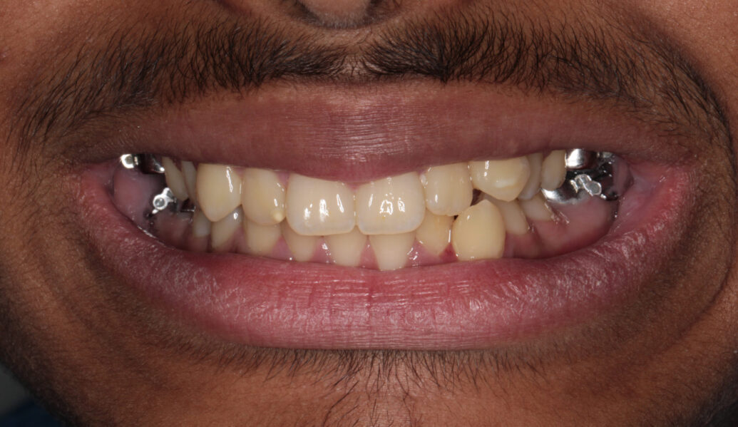 Before - Knighton Dental