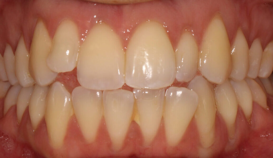 Before - Knighton Dental