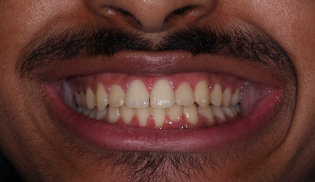 After - Knighton Dental