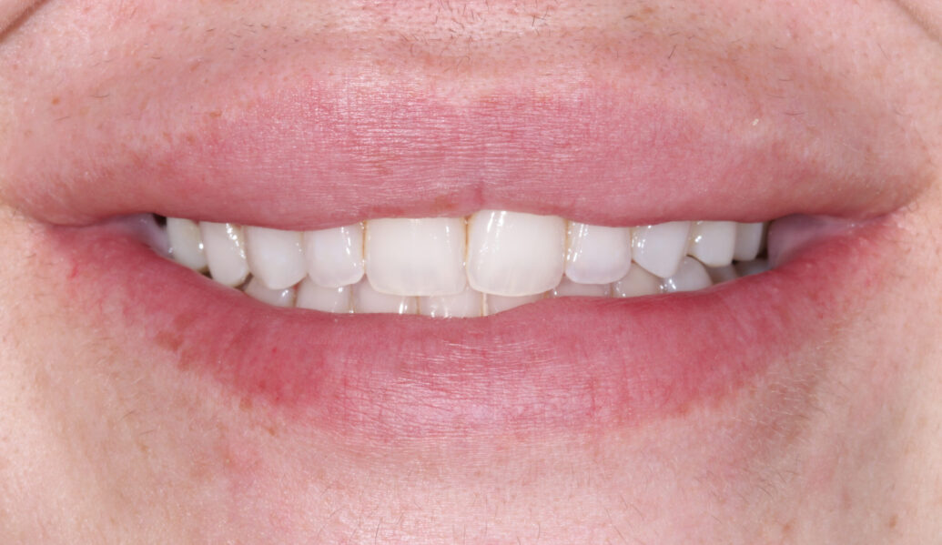 Before - Knighton Dental