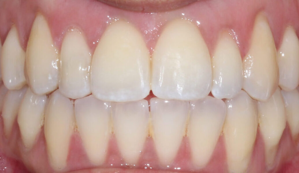 After - Knighton Dental