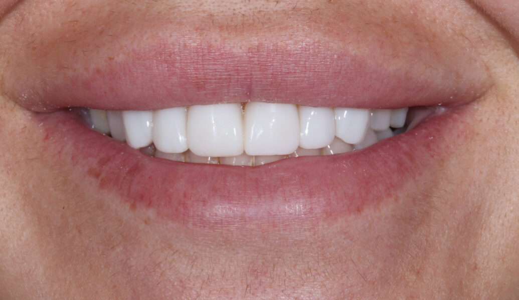 After - Knighton Dental