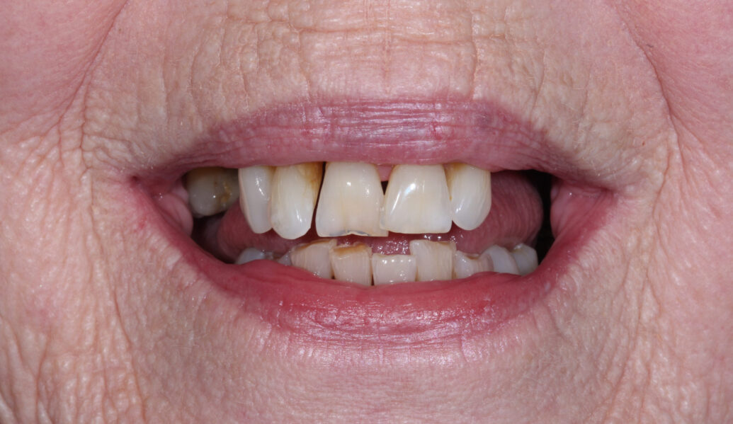 Before - Knighton Dental