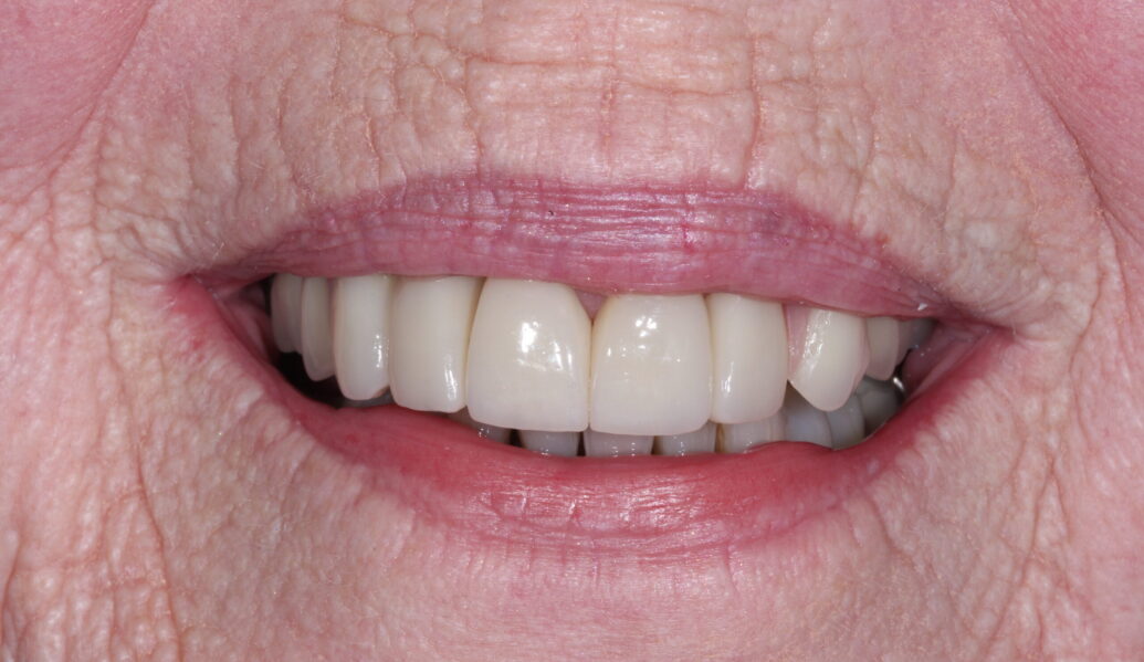 After - Knighton Dental