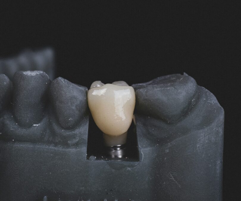 tooth_implants_leicester