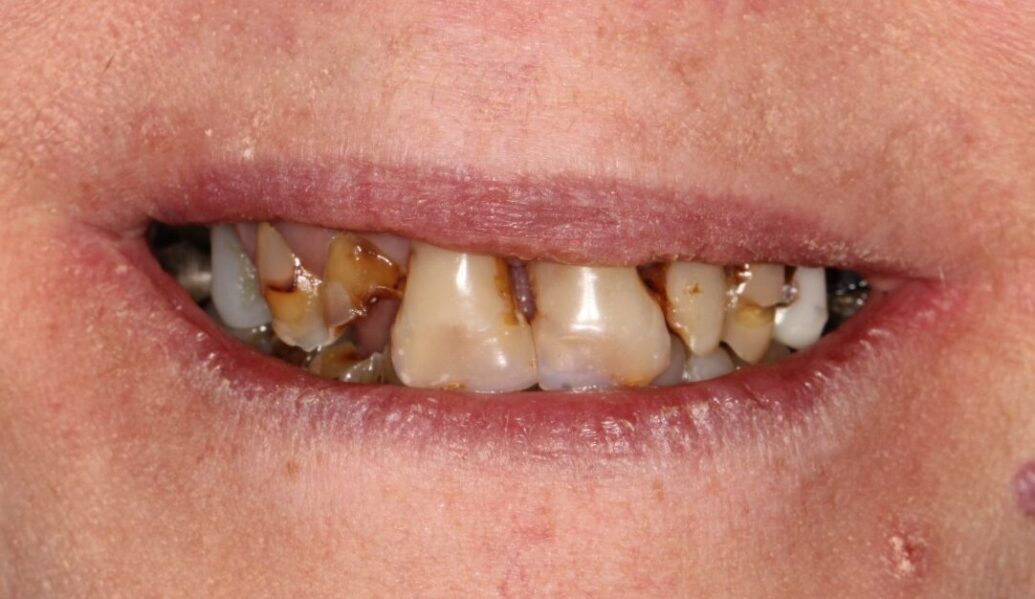 Before - Knighton Dental