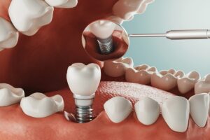 dental_implants_leicester