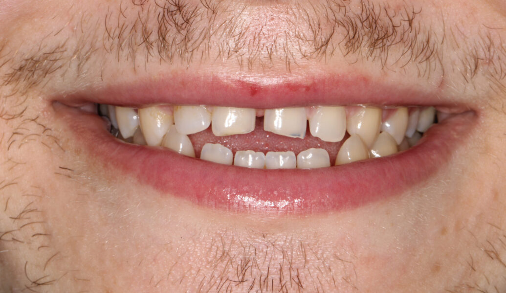 Before - Knighton Dental