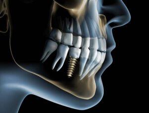 what is dental implant