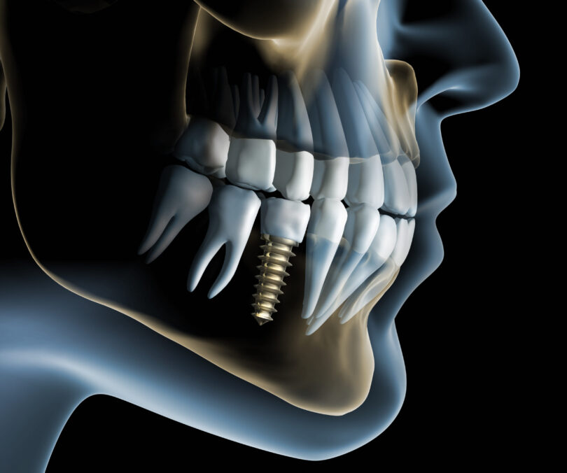 what is dental implant