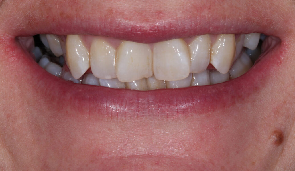 Before - Knighton Dental