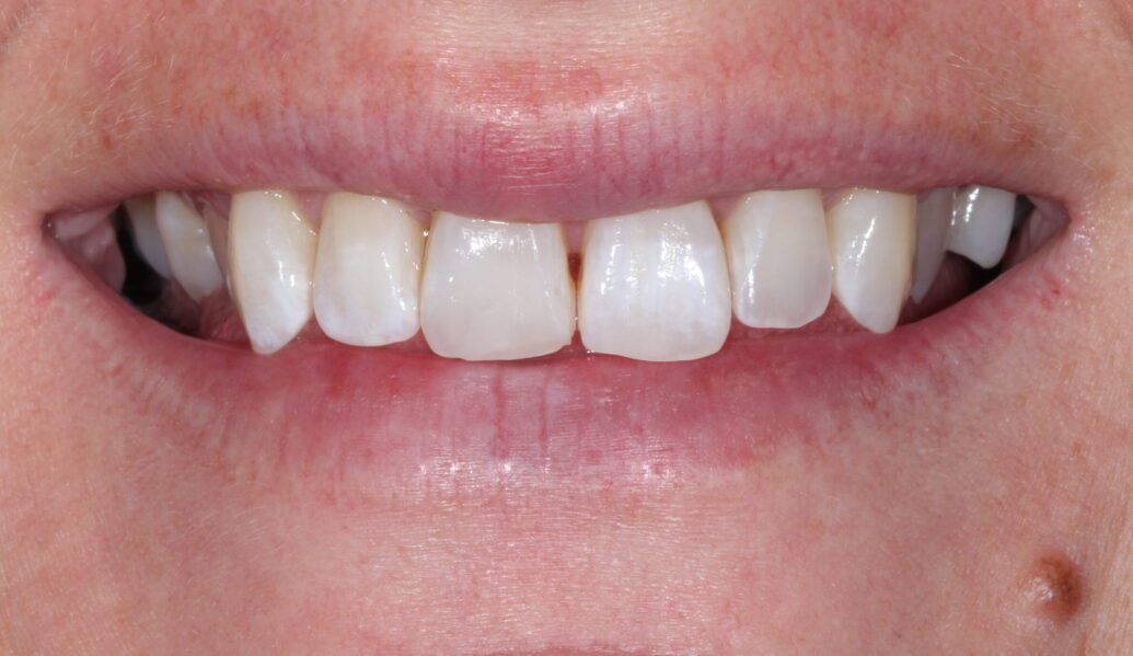 After - Knighton Dental