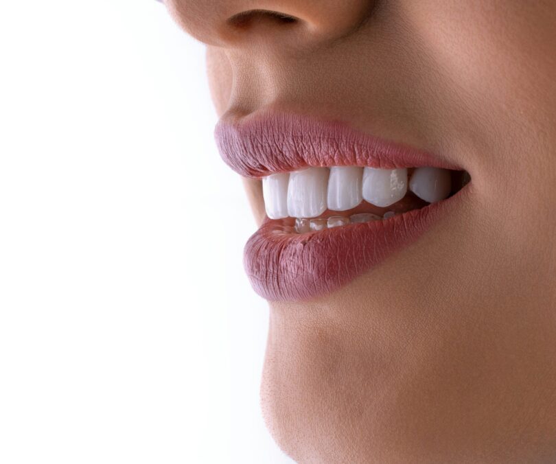 all about dental veneers